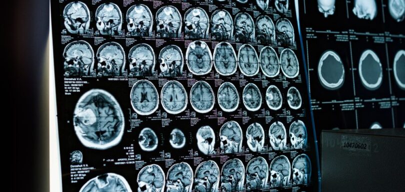 Services: Brain Surgery | Stroke Treatment | Neurological Tests | Rehabilitation